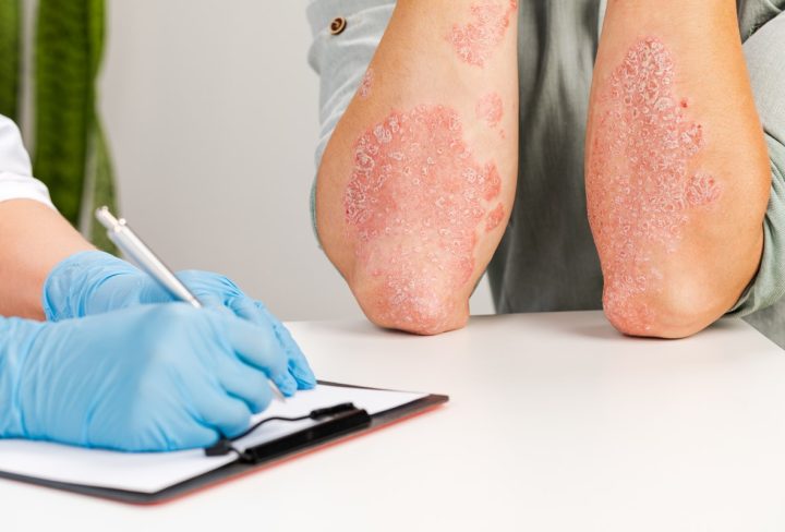 The Link Between Stress And Psoriasis - Managing Triggers And Symptoms